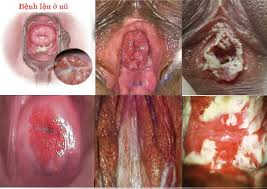 bệnh lậu ở nữ