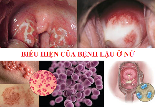 bệnh lậu ở nữ