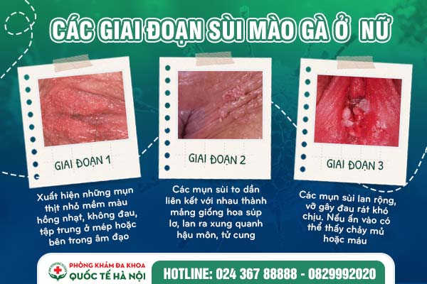 sùi mào gà ở nữ