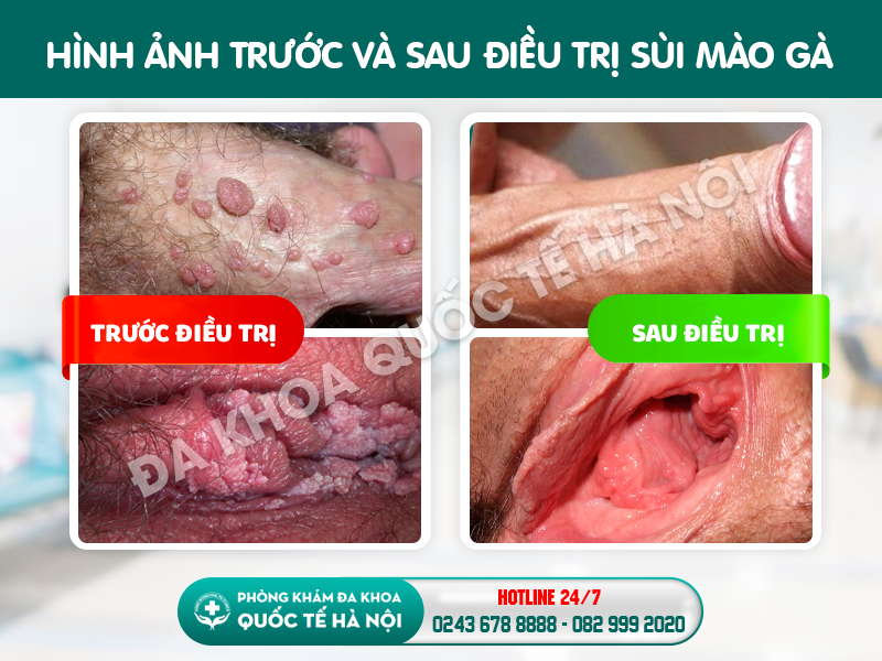 trước và sau điều trị sùi mào gà