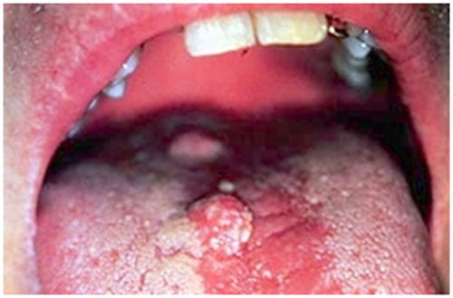 sùi mào gà ở lưỡi