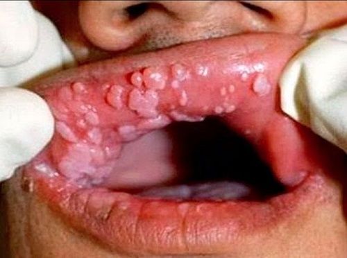 sùi mào gà ở môi