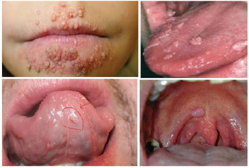 sùi mào gà ở miệng