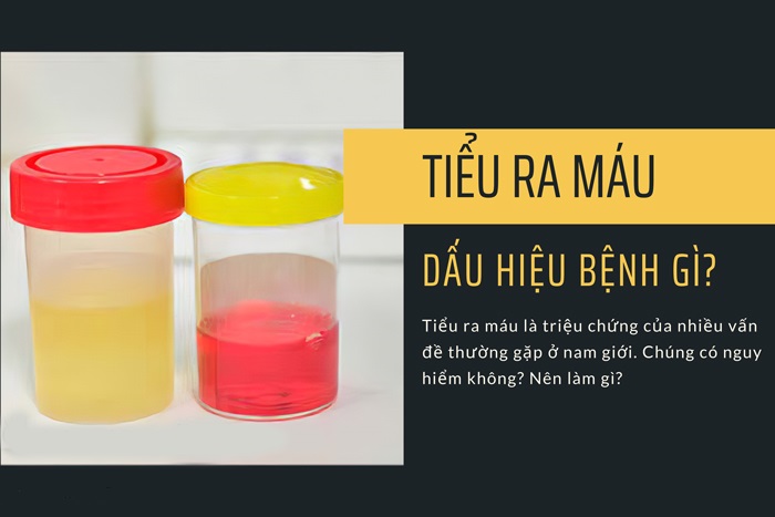 Nam Giới Bị Tiểu Ra Máu: Nguy Hiểm Gì Đang Tiềm Ẩn?