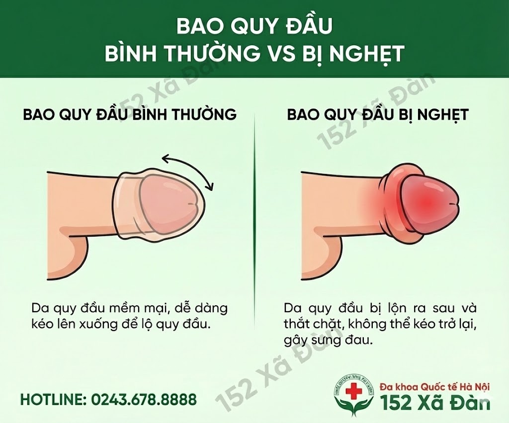 Nghẹt bao quy đầu là gì? Nguyên nhân, dấu hiệu và cách điều trị hiệu quả