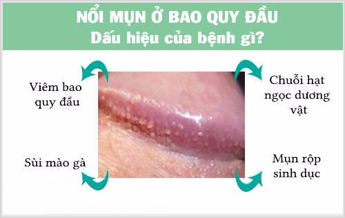 Cảnh Báo: Nổi Mụn Bao Quy Đầu Có Thể Là Triệu Chứng Của Bệnh Lây Qua Đường Tình Dục